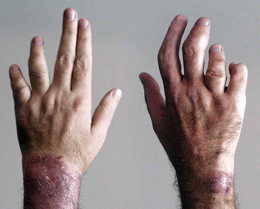 artritis psoriásica